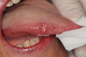 Ulcera Afta oral Santander-dentista santander